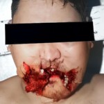 Suicide by firecracker in mouth