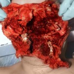 Suicide by firecracker in mouth