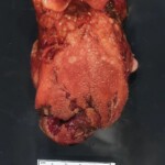 Suicide by firecracker in mouth