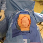 Surgery on patient who was injured in rodeo practice