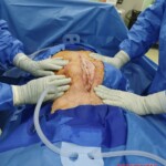 Surgery on patient who was injured in rodeo practice