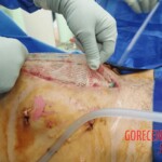 Surgery on patient who was injured in rodeo practice