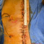 Surgery on patient who was injured in rodeo practice