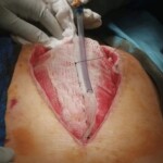 Surgery on patient who was injured in rodeo practice