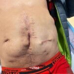 Surgery on patient who was injured in rodeo practice