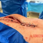 Surgery on patient who was injured in rodeo practice