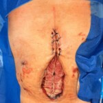 Surgery on patient who was injured in rodeo practice