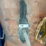 Surgery on patient who was injured in rodeo practice