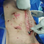 Surgery on patient who was injured in rodeo practice