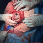 Surgery on patient who was injured in rodeo practice