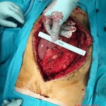 Surgery on patient who was injured in rodeo practice