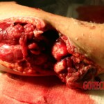 Arm wound caused by a .50cal bullet