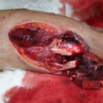 Arm wound caused by a .50cal bullet