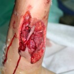 Arm wound caused by a .50cal bullet