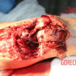 Arm wound caused by a .50cal bullet