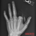 Finger bitten off by alligator snapping turtle