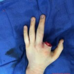 Finger bitten off by alligator snapping turtle