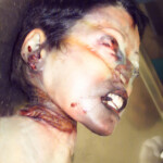 Hanged woman in morgue