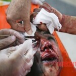 Chaharshanbe Soori injury