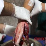 Chaharshanbe Soori injury