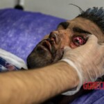 Chaharshanbe Soori injury