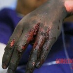 Chaharshanbe Soori injury