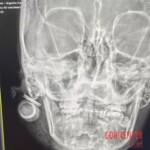 Woman is hit in face with rubber bullet