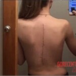 Scoliosis surgery