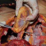 Autopsy of Chinese woman hacked with machete