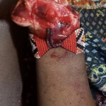 Colombian woman after brutal machete attack by her boyfriend