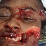 Colombian woman after brutal machete attack by her boyfriend