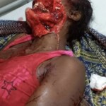 Colombian woman after brutal machete attack by her boyfriend