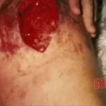 Consequences of Brown recluse spider bite