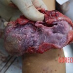 Examination of strangled and raped woman