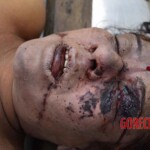 Examination of strangled and raped woman