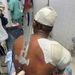 Guy arrived at hospital with sword stuck in his shoulder