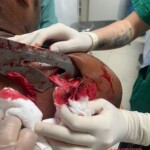 Guy arrived at hospital with sword stuck in his shoulder