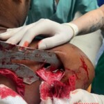 Guy arrived at hospital with sword stuck in his shoulder