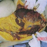 Vintage photo of dead woman