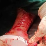 Surgical reconstruction of crushed arm