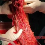 Surgical reconstruction of crushed arm