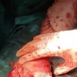 Surgical reconstruction of crushed arm