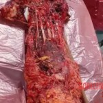 Surgical reconstruction of crushed arm