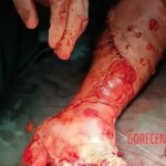 Surgical reconstruction of crushed arm