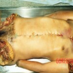 Completely dismembered woman in morgue