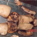 Completely dismembered woman in morgue