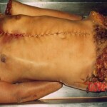 Completely dismembered woman in morgue