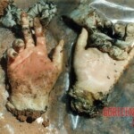 Completely dismembered woman in morgue