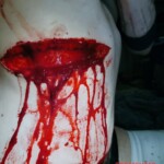 Deep cut on ribs of anorexic woman