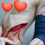 Deep cut on ribs of anorexic woman